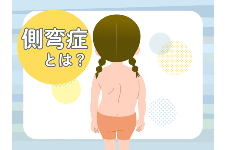 側湾症のイラストです。
側湾症とは?と書かれています。