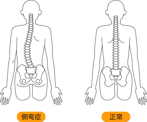 側湾症のイラスト「側湾症」「正常」2種類のイラストです。