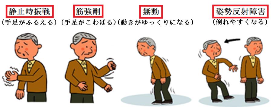 パーキンソン病の症状を表したイラストです。