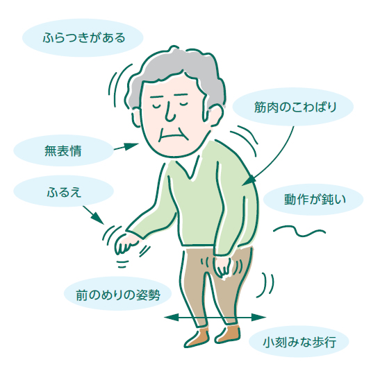 パーキンソン病になってしまった高齢男性のイラストです。様々な症状が出ています。