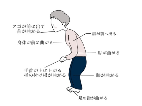 パーキンソン病の特徴を表したイラストです。