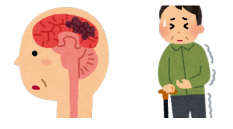 脳梗塞後遺症で片麻痺の高齢男性が杖で立っているイラストです。